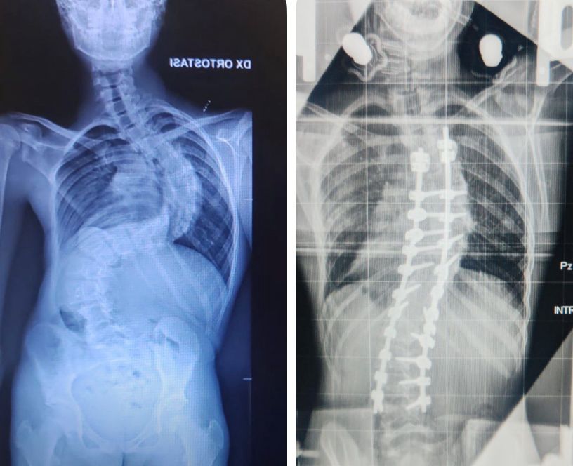 Il regalo più atteso: dopo un mese in ospedale, Francesco torna a casa per Natale