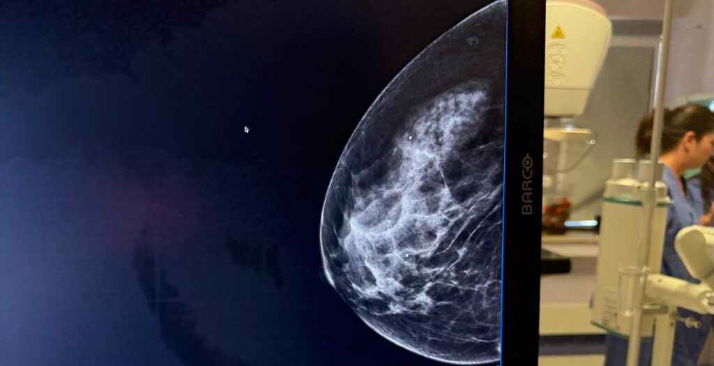 Tumore al seno, l’Ospedale di Molfetta potenzia la diagnostica grazie alla mammografia con mezzo di contrasto